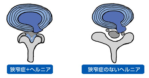 椎間板