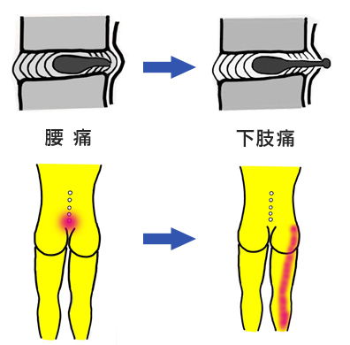 腰痛から下肢痛へ