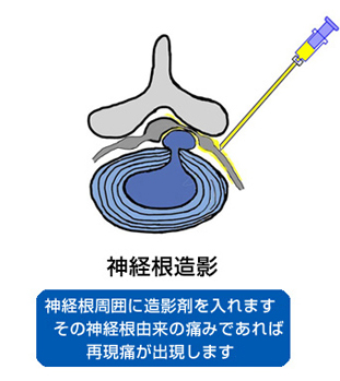 MRIによるヘルニア像