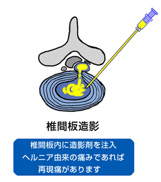 MRIによるヘルニア像