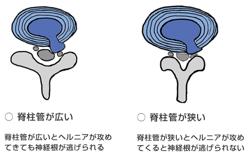 脊柱管の広いヘルニアと狭いヘルニア